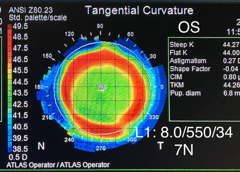 What to expect from Ortho-K treatment and overnight corneal reshaping
